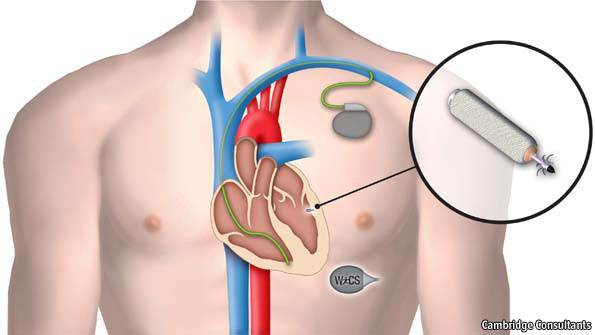 wireless_pacemaker.jpg